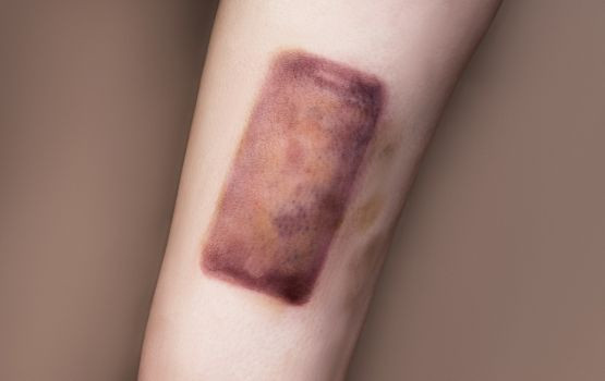 Image of a bruise in the shape of a cellphone.